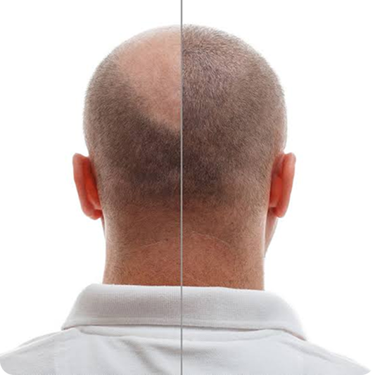 Tratamientos e Implantes Capilares